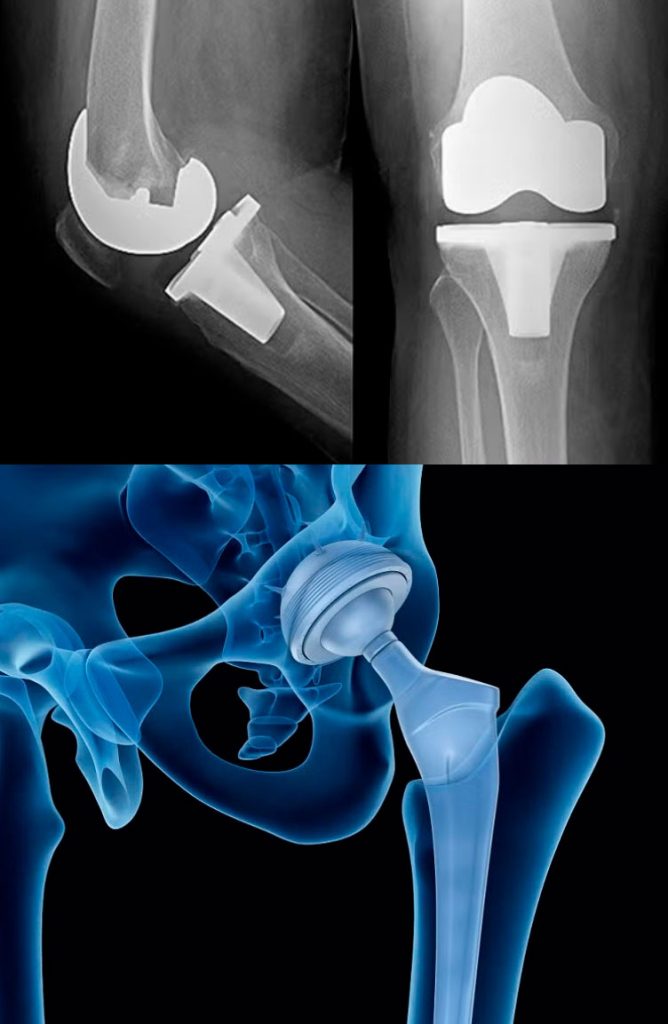 foto-artroplastia